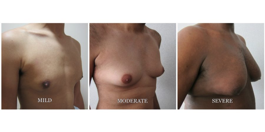 dominick scott add photo large breasts puffy nipples
