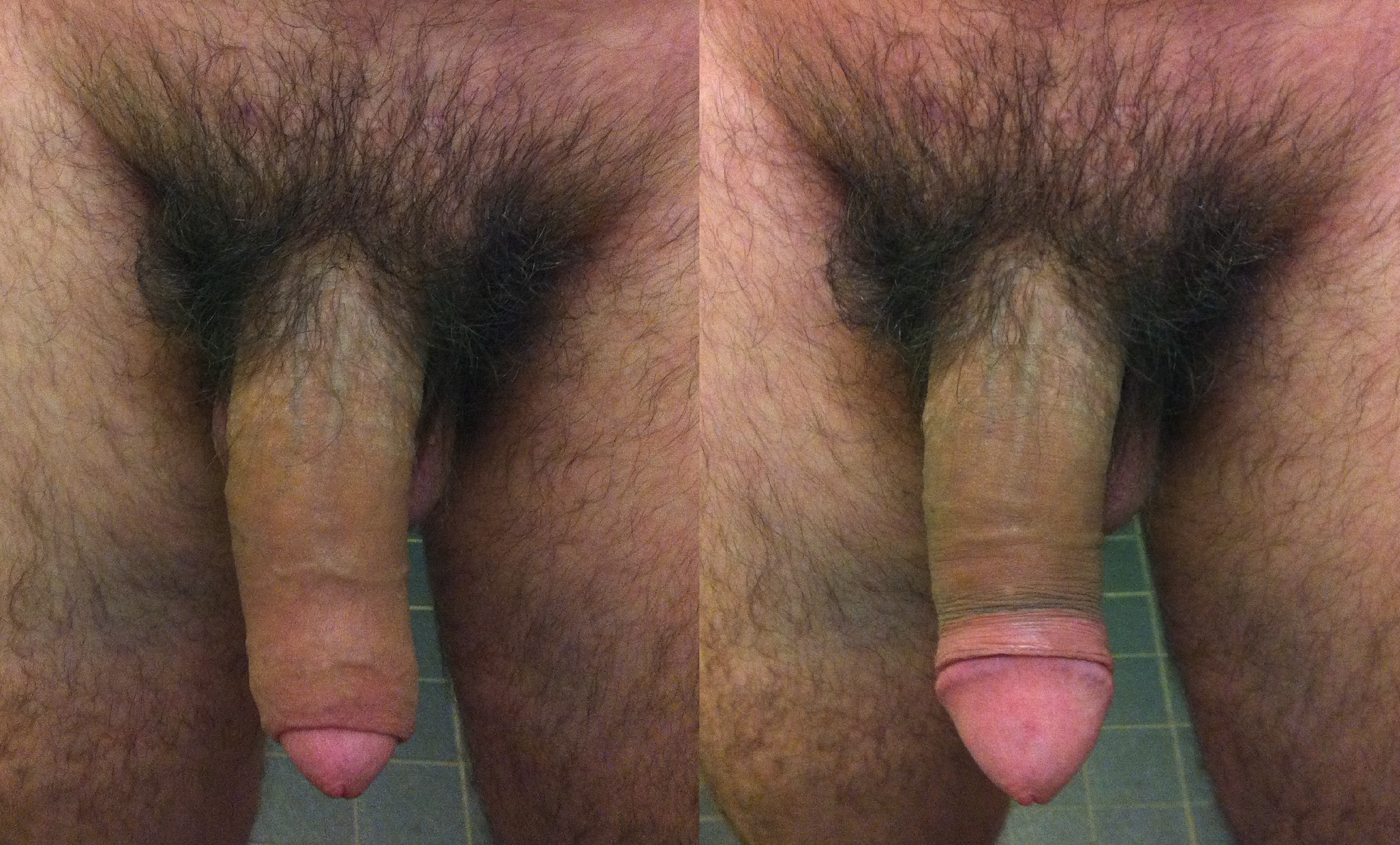 Best of Pics of uncut penis