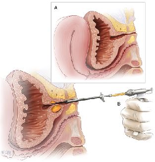 colin suter add injecting air into urethra photo