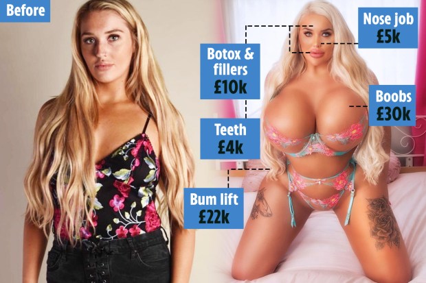 cody england recommends 4000 Cc Breast Implants