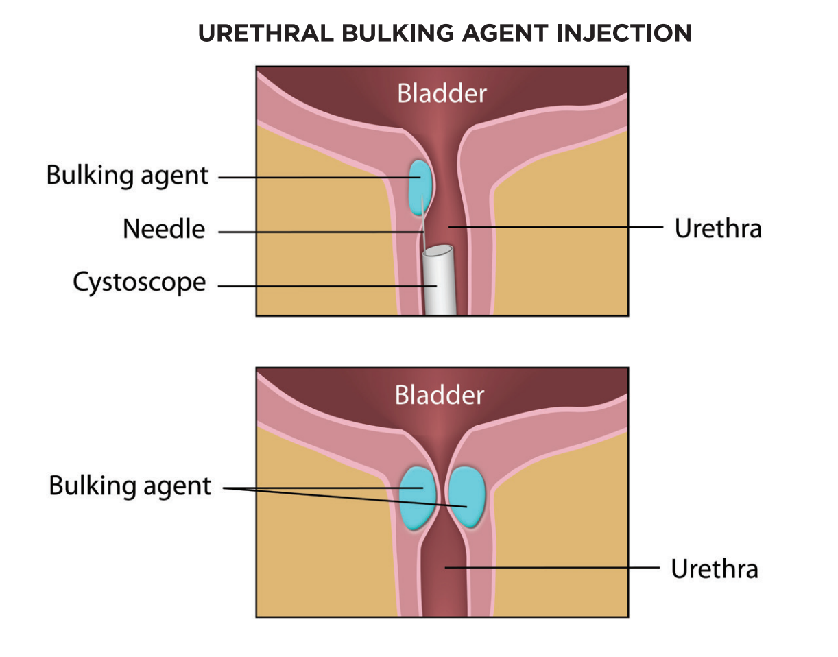 audrey buckingham recommends Injecting Air Into Urethra