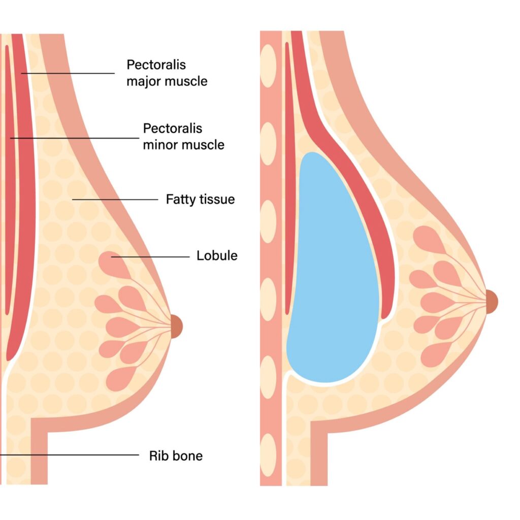 dafna bar add photo 6000 cc breast implants