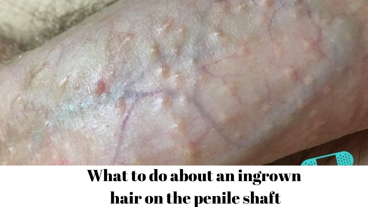 alexandra may share how to remove hair from penis photos
