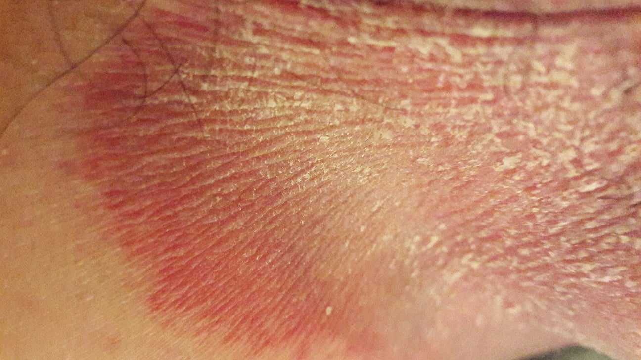 why is my buthole so itchy