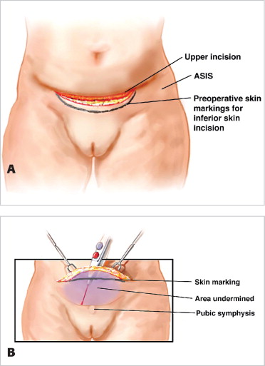 cathy groh recommends enlarged mons pubis pictures pic