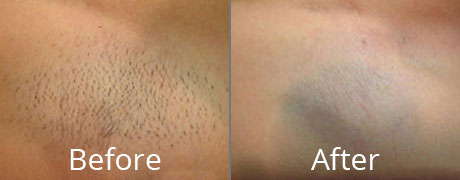 ashla sands recommends brazilian wax before and after pictures pic