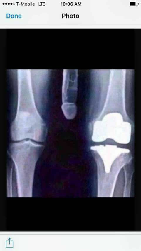 xray with big penis