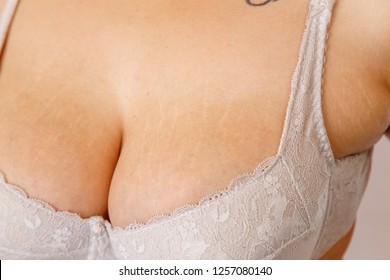 bob wax recommends tits with stretch marks pic