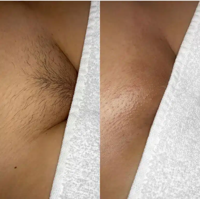 bunda ihsan recommends brazilian wax before and after pictures pic