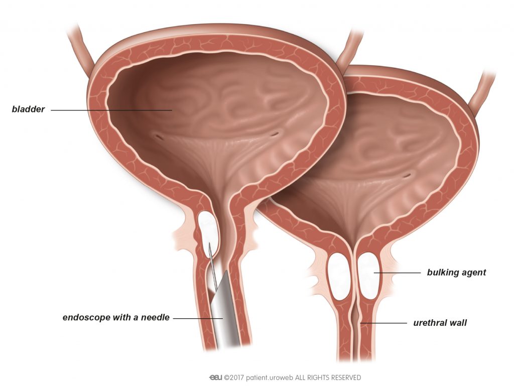 baboo lal add photo injecting air into urethra